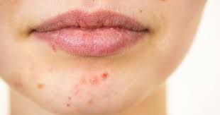 How to get rid of adult acne