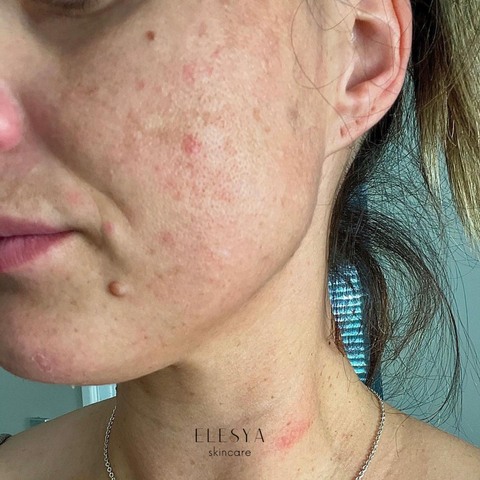 Clear Skin Serum