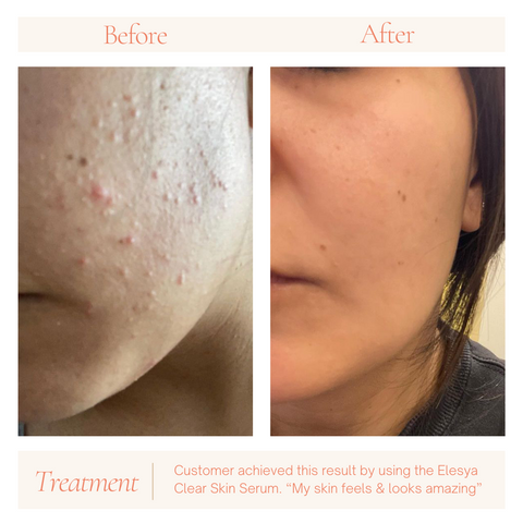 Glow Bundle - Clear Skin Serum