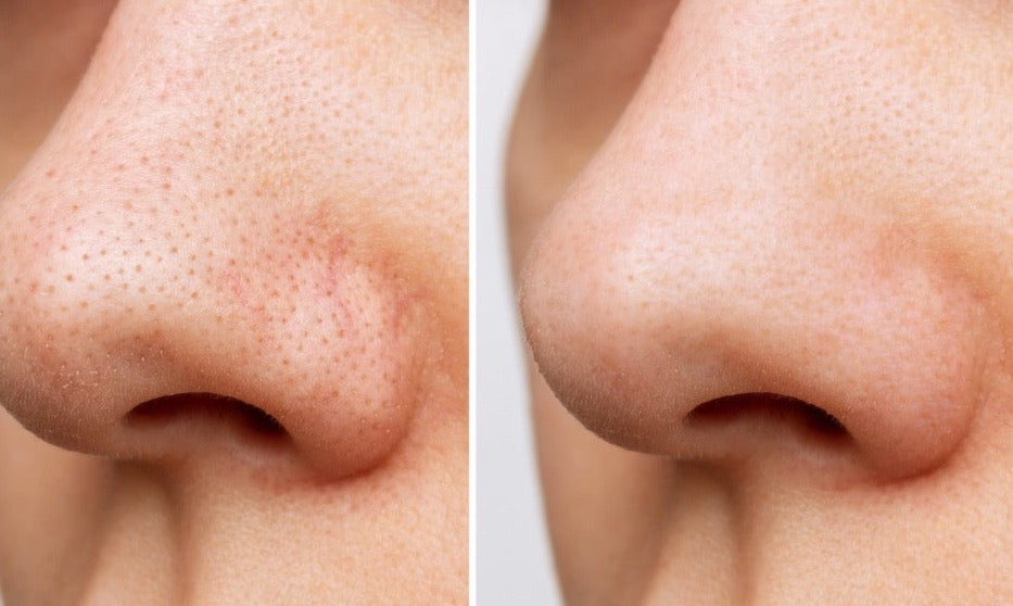 Elesya skincare Blemish remover acne remover before and after reduce redness Australian made natural skincare suitable for sensitive skin acne serum